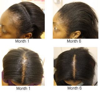   JAMAICAN BLACK CASTOR OIL for Traction Alopecia Hair Extension Damage