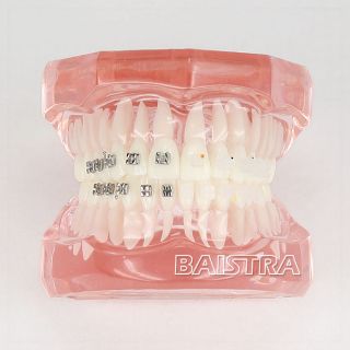 New Dental Study Teeth model Orthodontics with Metal and Ceramic 