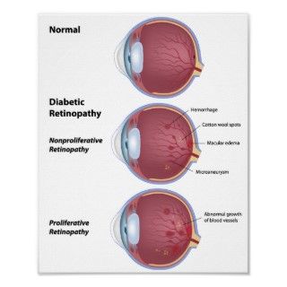 Eye disease Diabetic retinopathy Poster 